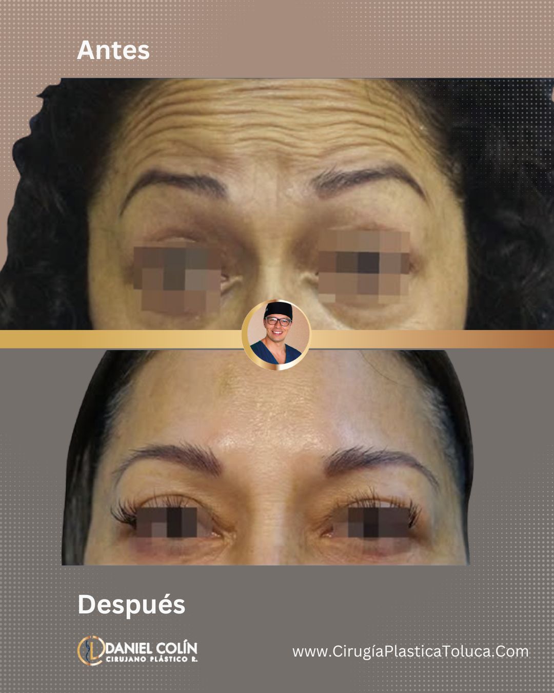 Aplicación en Toluca y Metepec de Toxina Botulínica (Botox)