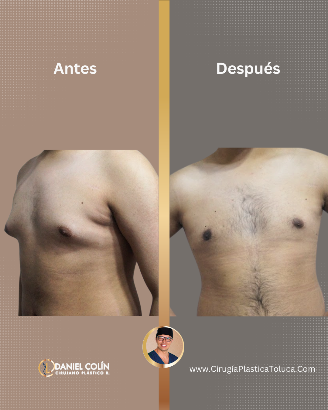 ginecomastia con el Dr Daniel Colin Cirujano Plástico certificado en Toluca y Metepec