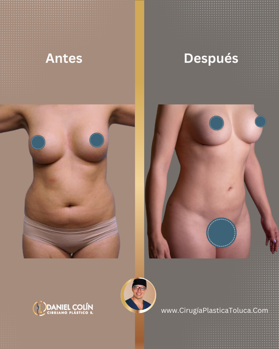 lipoescultura con el Dr Daniel Colin cirujano Plástico y reconstructivo certificado en el Estado de México
