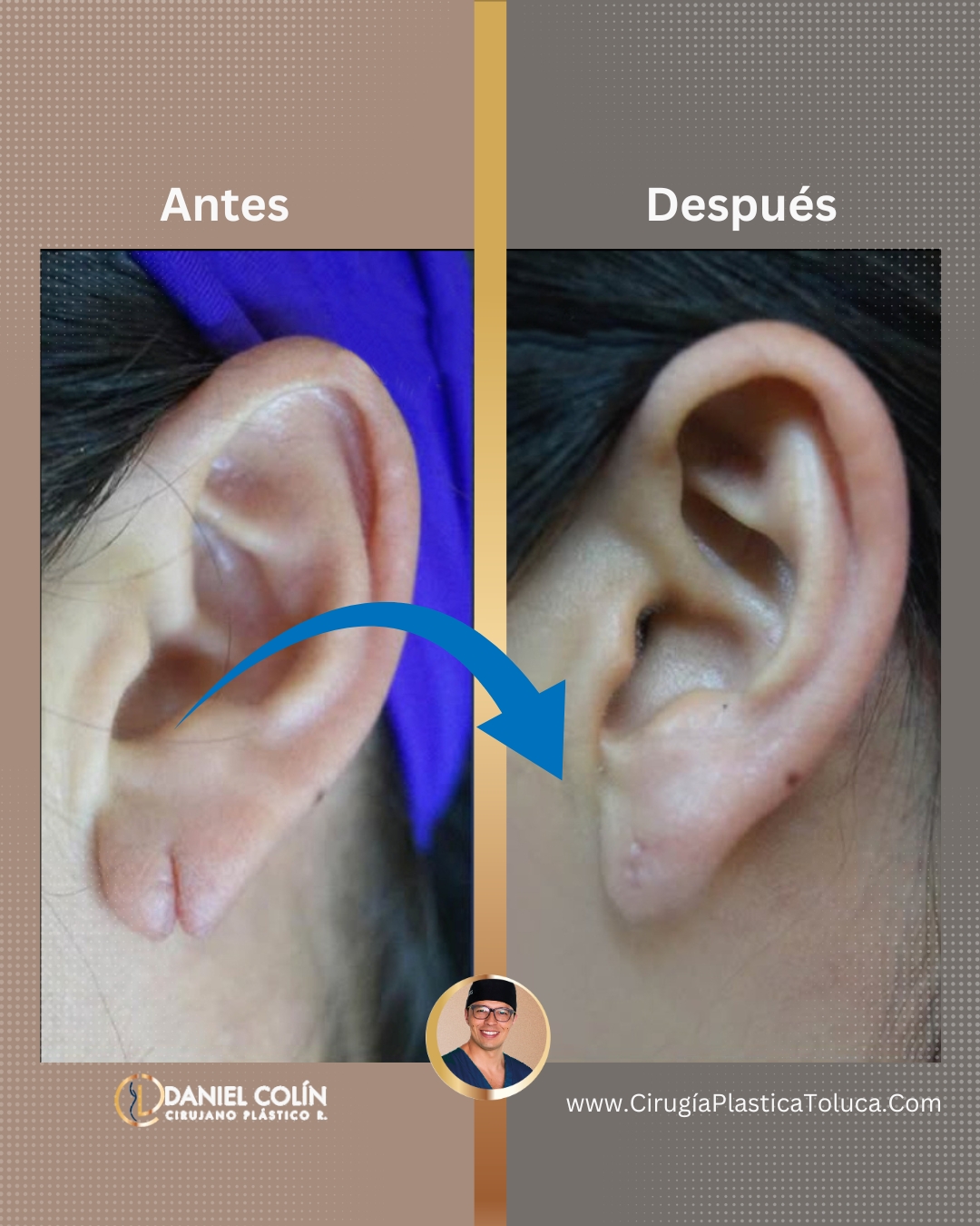 lobuloplastia con el Dr Daniel Colin antes y después