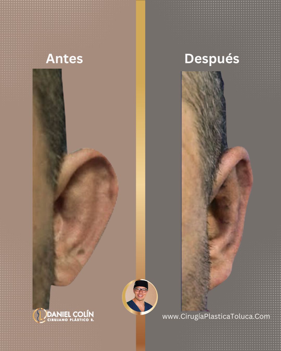 Otoplastia con cirujano Plástico en Toluca