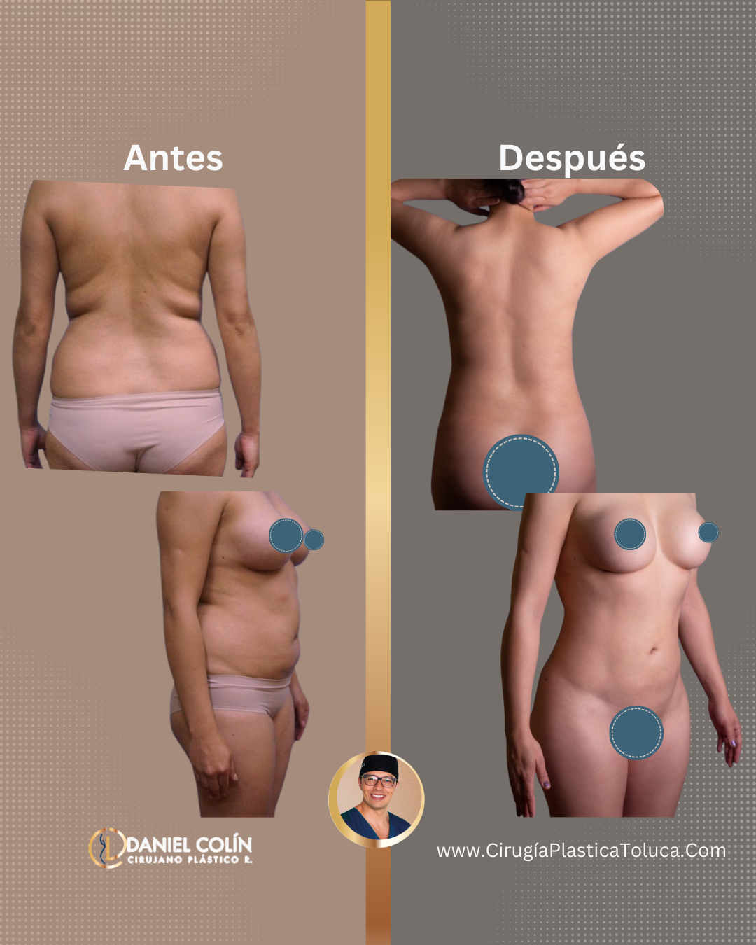 paciente lipoescultura Dr Daniel Colin Cirujano Plástico certificado en Toluca y Metepec