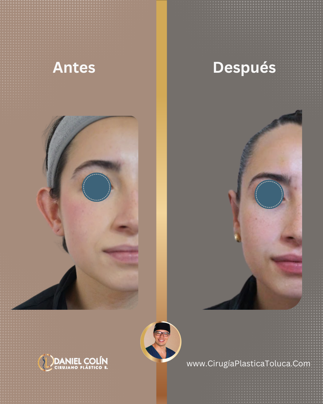 Otoplastia paciente mujer Cirugía Plástica en Toluca Dr Daniel Colin Certificado